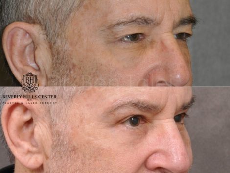 Brow & Eyelid Ptosis Repair with Lower Eyelid Rejuvenation - Right Side