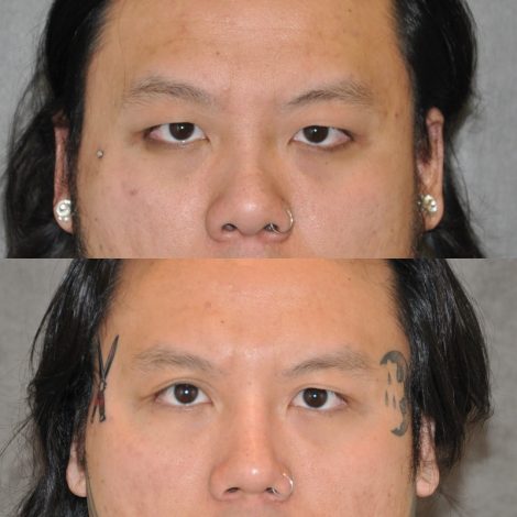 Asian Eyelid Procedure, Rhinoplasty, Neck MicroLiposuction - Front