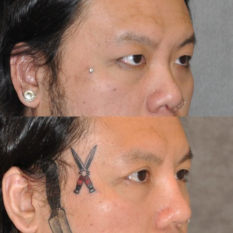 Asian Eyelid Procedure, Rhinoplasty, Neck MicroLiposuction - Right Side
