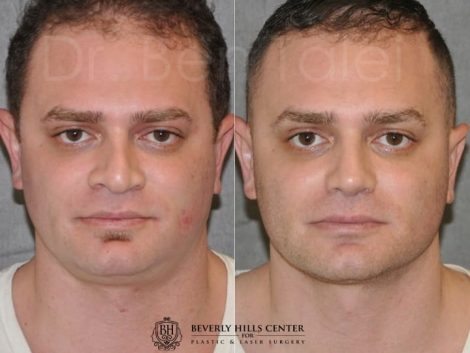 Beverly Hills Center Male Patient Before and After Revision Rhinoplasty and Profound MicroLift Procedure