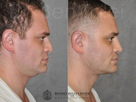 Beverly Hills Center Male Patient Before and After Revision Rhinoplasty and Profound MicroLift Procedure