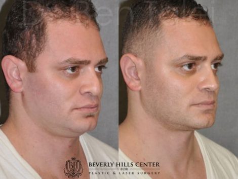 Beverly Hills Center Male Patient Before and After Revision Rhinoplasty and Profound MicroLift Procedure