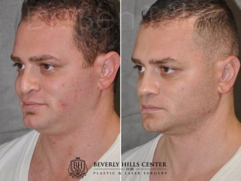Beverly Hills Center Male Patient Before and After Revision Rhinoplasty and Profound MicroLift Procedure