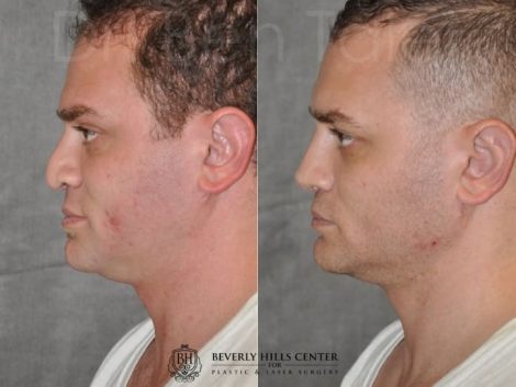 Beverly Hills Center Male Patient Before and After Revision Rhinoplasty and Profound MicroLift Procedure