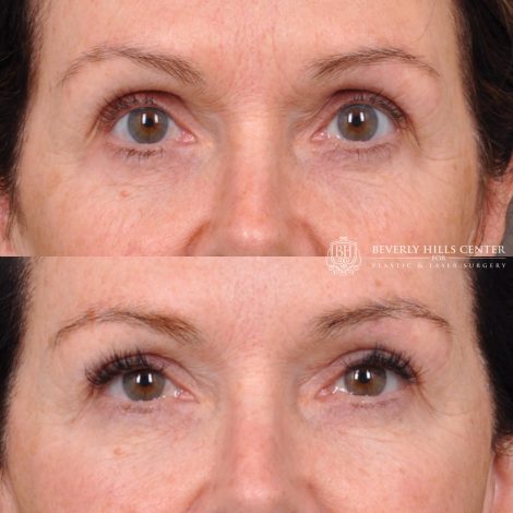 Upper Bleph with fat repositioning and micro fat grafting - Front