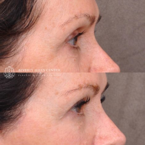 Upper Bleph with fat repositioning and micro fat grafting - Right Side