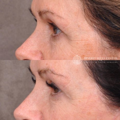 Beverly Hills Center Upper Bleph with fat repositioning and micro fat grafting