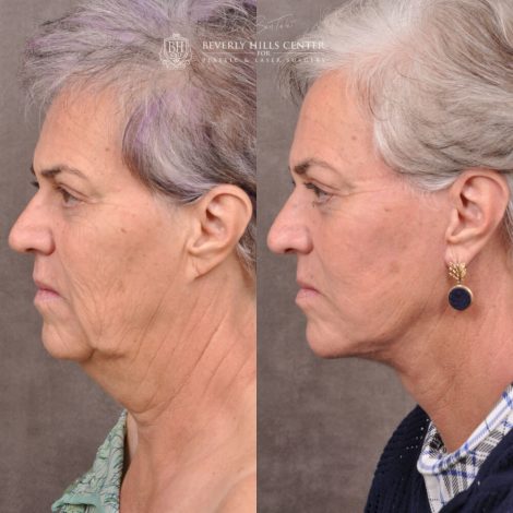 mature female patient before and after Auralyft procedure