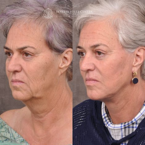 mature female patient before and after Auralyft procedure