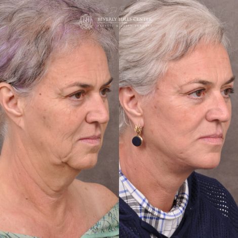 mature female patient before and after Auralyft procedure