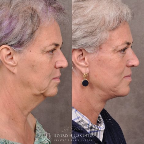 mature female patient before and after Auralyft procedure