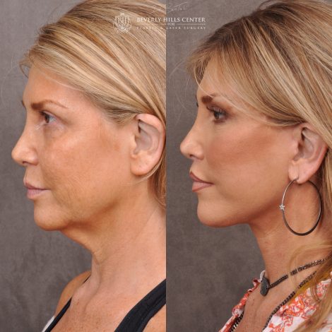 Auralyft & Deep Plane Upper Lip Lift - Left Side