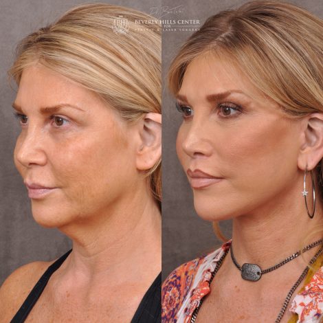 Auralyft & Deep Plane Upper Lip Lift - Left Side