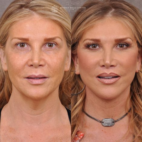 Auralyft & Deep Plane Upper Lip Lift - Front