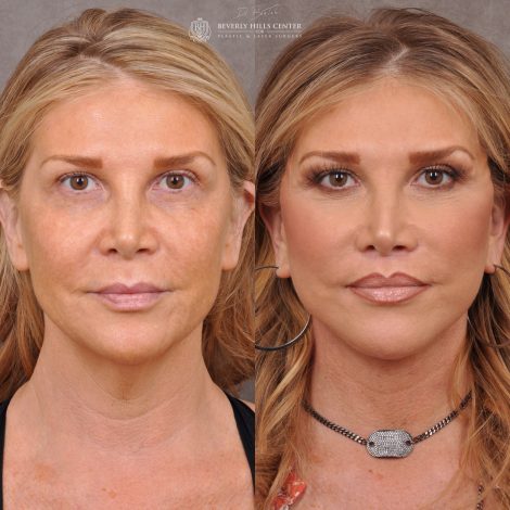 Auralyft & Deep Plane Upper Lip Lift - Front
