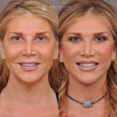 Auralyft & Deep Plane Upper Lip Lift - Front