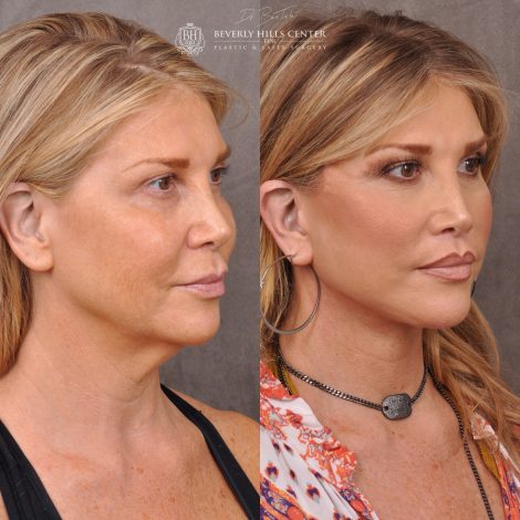 Auralyft & Deep Plane Upper Lip Lift - Right Side