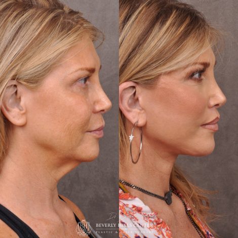 Auralyft & Deep Plane Upper Lip Lift - Right Side
