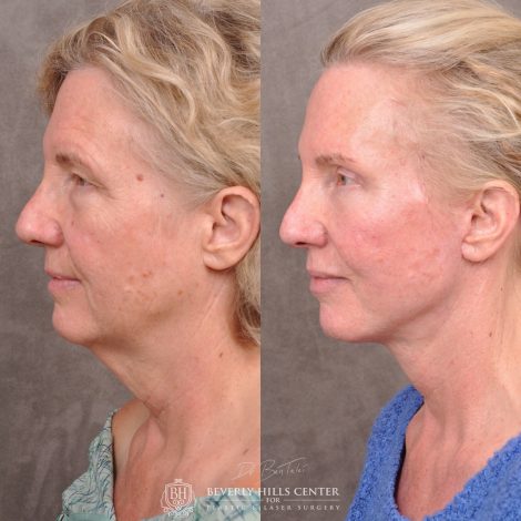 Auralyft and Mini Brow Lift - Left Side