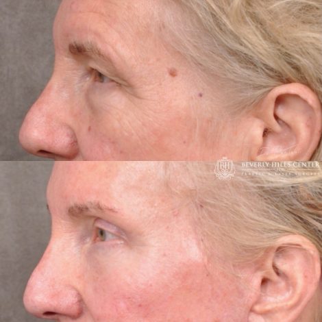 Auralyft and Mini Brow Lift
