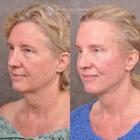Auralyft and Mini Brow Lift - Left Side