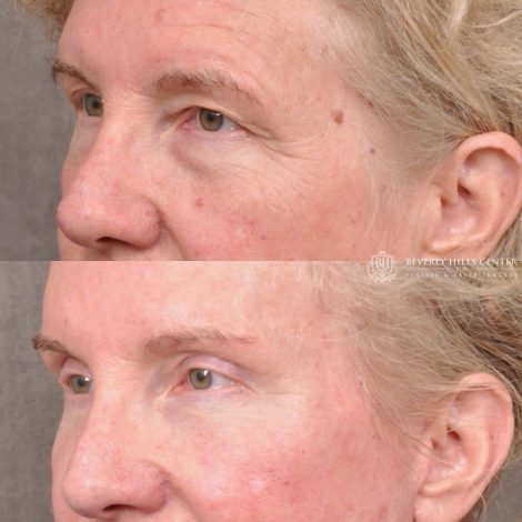 Auralyft and Mini Brow Lift