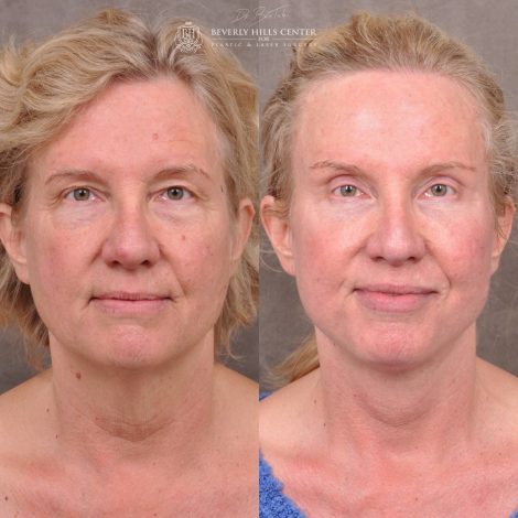 Auralyft and Mini Brow Lift - Front