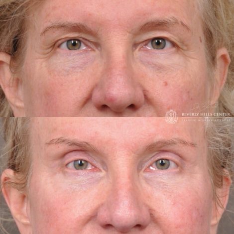 Auralyft and Mini Brow Lift