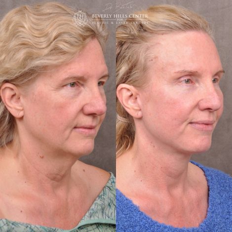 Auralyft and Mini Brow Lift - Right Side