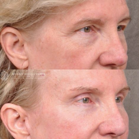 Auralyft and Mini Brow Lift