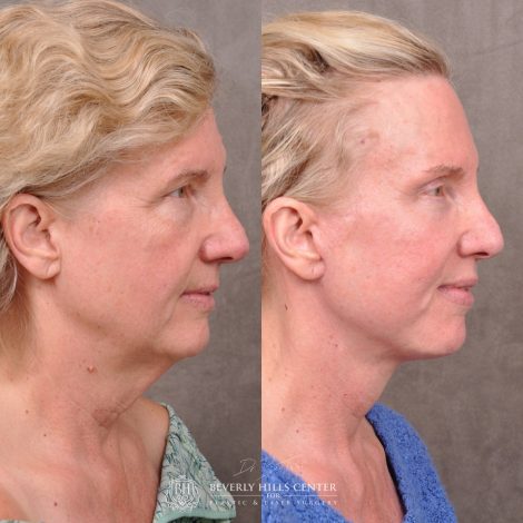 Auralyft and Mini Brow Lift - Right Side