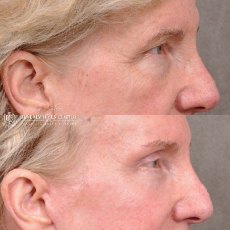 Auralyft and Mini Brow Lift