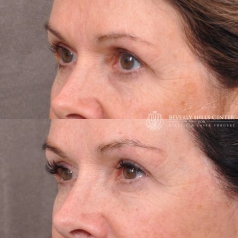 Upper Bleph with fat repositioning and micro fat grafting - Left Side