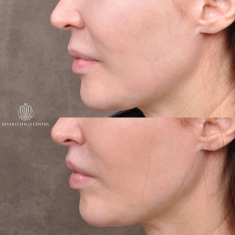 Beverly Hills Center Patient Before and After Modified Upper Lip Lift