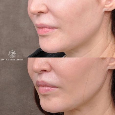 Beverly Hills Center Patient Before and After Modified Upper Lip Lift