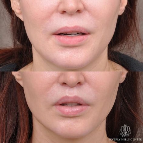 Beverly Hills Center Patient Before and After Modified Upper Lip Lift