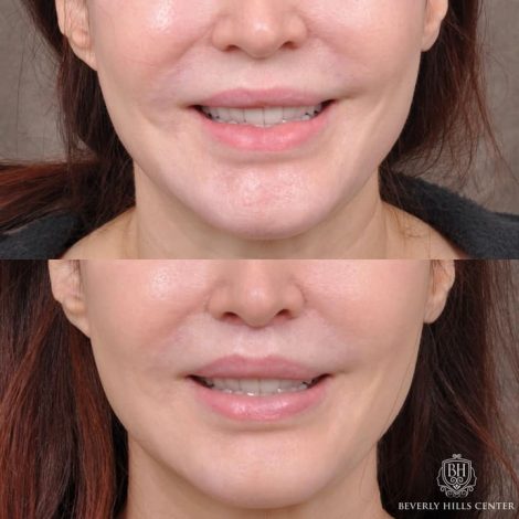 Beverly Hills Center Patient Before and After Modified Upper Lip Lift