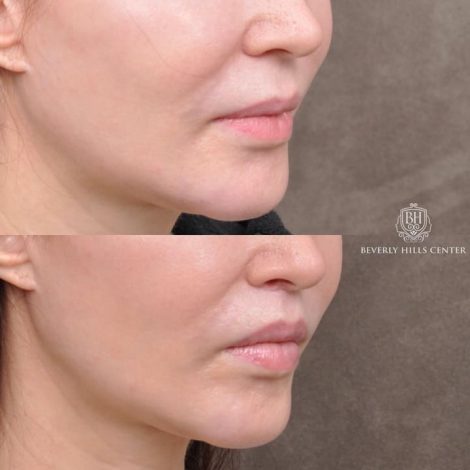 Beverly Hills Center Patient Before and After Modified Upper Lip Lift
