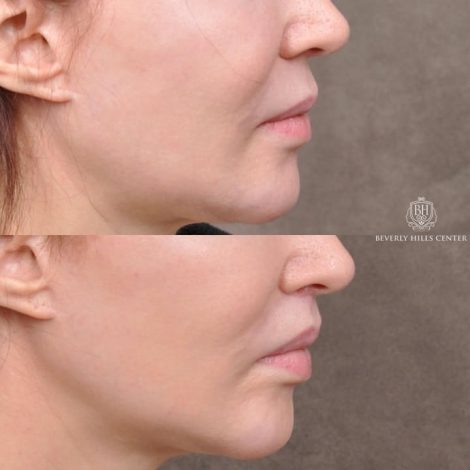 Beverly Hills Center Patient Before and After Modified Upper Lip Lift