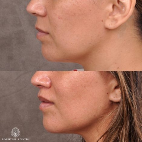 Modified Upper Lip Lift / Deep Plane Upper Lip Lift