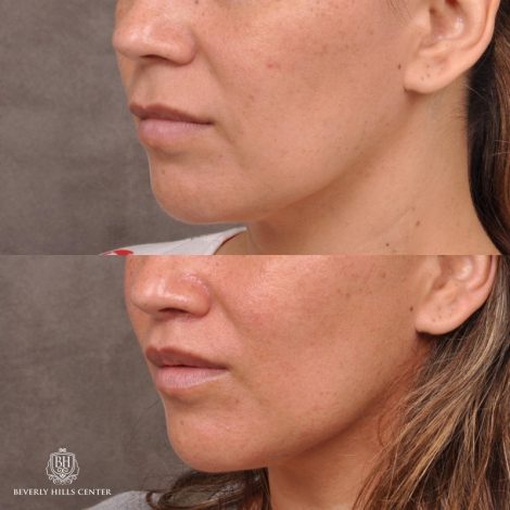Modified Upper Lip Lift / Deep Plane Upper Lip Lift