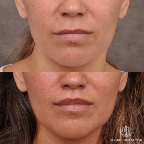 Modified Upper Lip Lift / Deep Plane Upper Lip Lift
