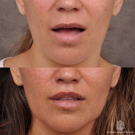 Modified Upper Lip Lift / Deep Plane Upper Lip Lift