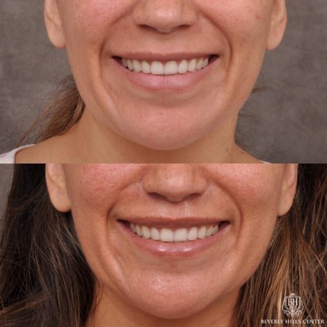 Modified Upper Lip Lift / Deep Plane Upper Lip Lift