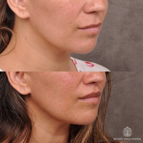 Modified Upper Lip Lift / Deep Plane Upper Lip Lift