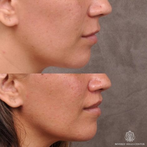 Modified Upper Lip Lift / Deep Plane Upper Lip Lift