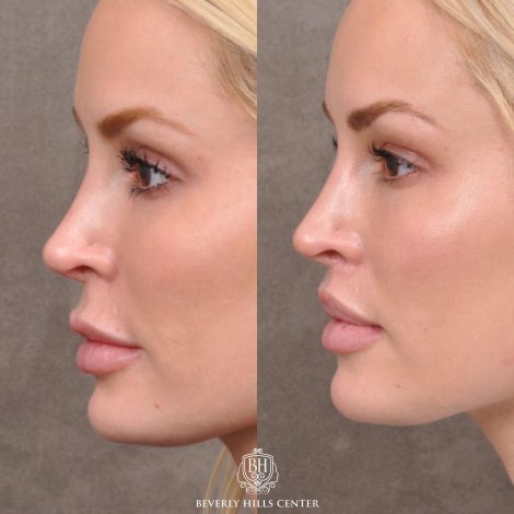 Moddified Upper Lip Lift with Deep Release with Infra Brow Filler - Left Side