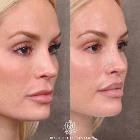 Moddified Upper Lip Lift with Deep Release with Infra Brow Filler - Right Side