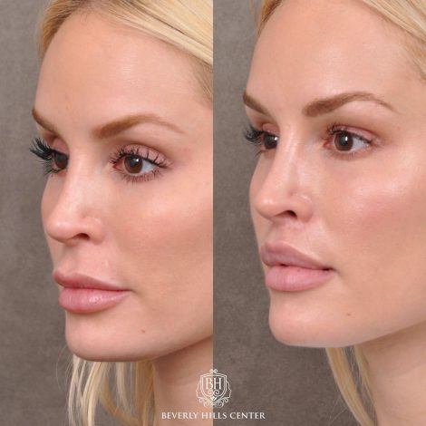 Moddified Upper Lip Lift with Deep Release with Infra Brow Filler - Left Side