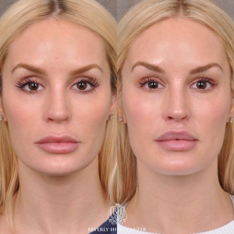 Moddified Upper Lip Lift with Deep Release with Infra Brow Filler - Front